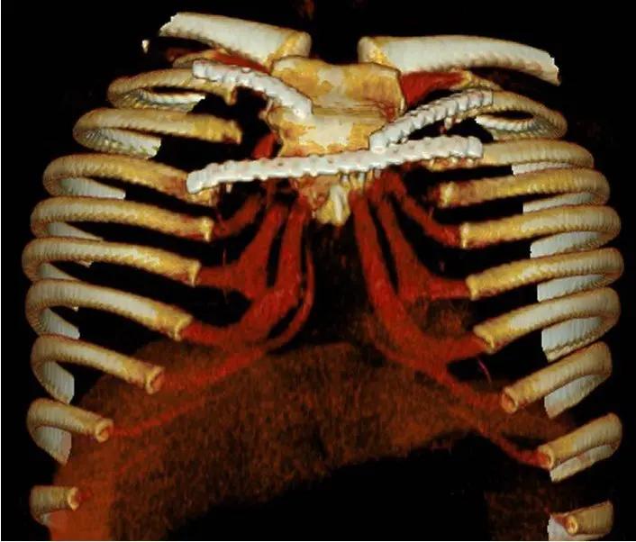 3D CT after revision, from below