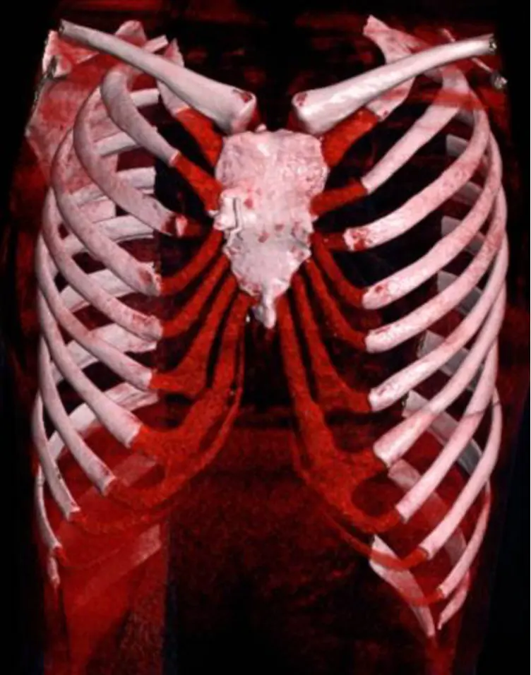 3D CT before revision, front view