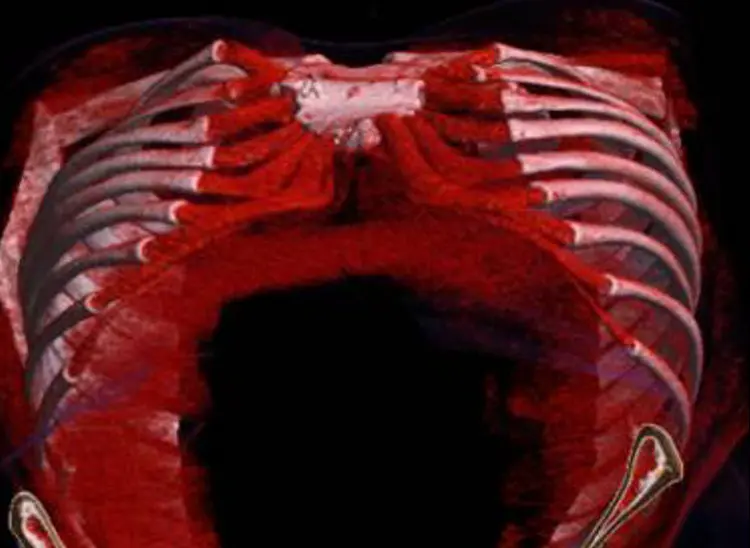 3D CT before revision, from below