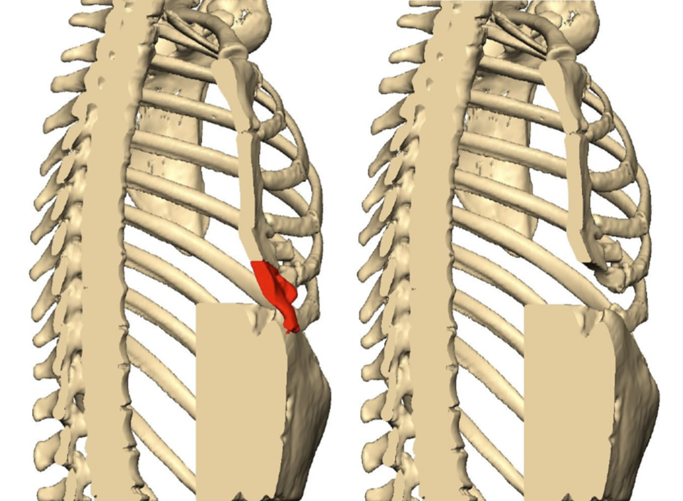 CT reconstruction highlighting area of residual pectus excavatum with protrusion