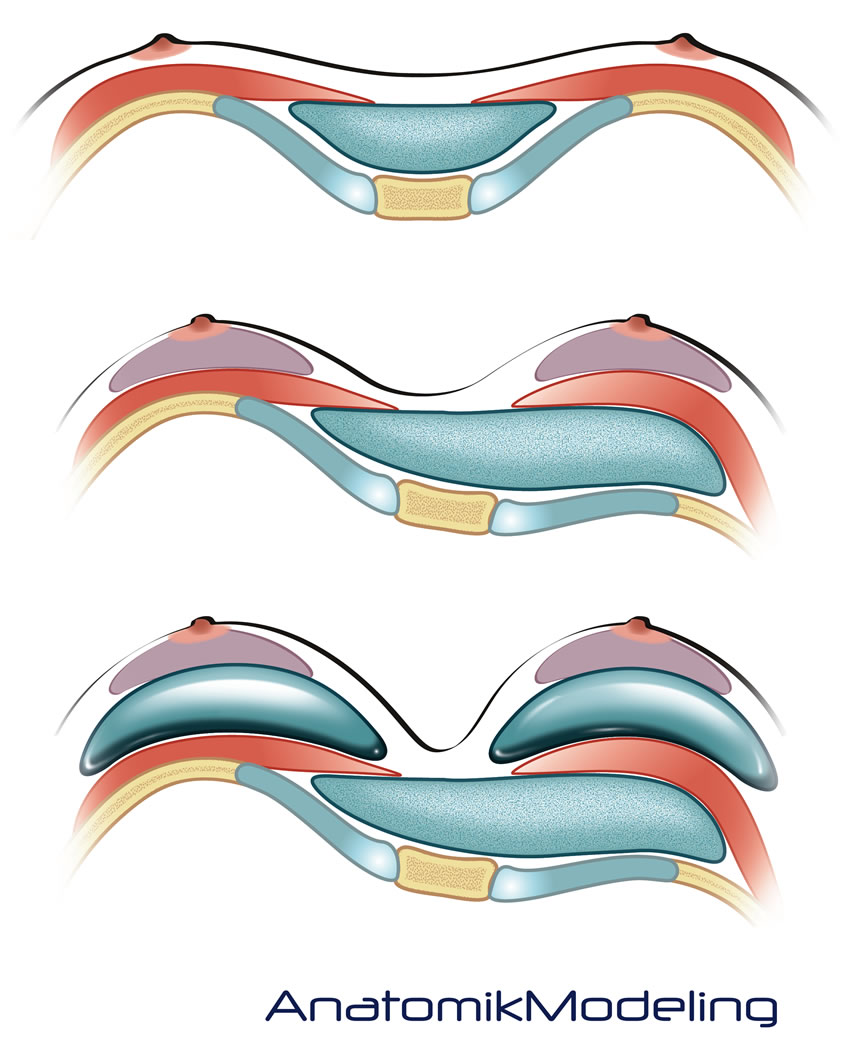 Custom made pectus implants corrects the pectus excavatum