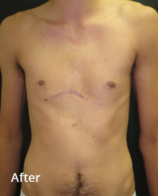 Eight weeks after pectus non-corrective surgery with pectus implant inserted