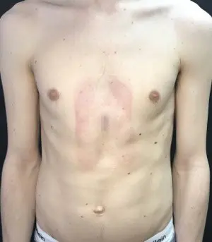 Eight months after surgery
