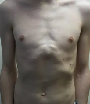 Pectus carinatum before surgery