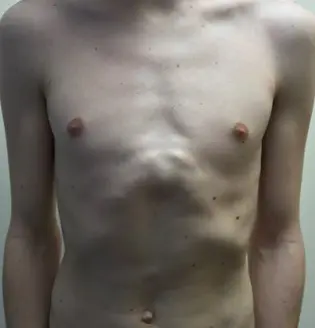 Hybrid and combined pectus surgery — Pectus Clinic