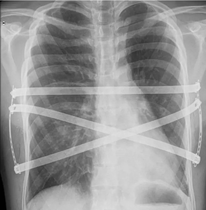 Front-view X-ray after surgery, three bars