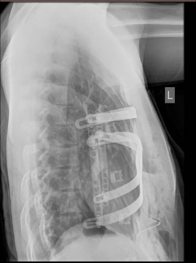 Side-view X-ray after surgery