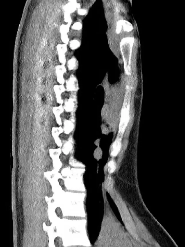 Side-view X-ray before surgery