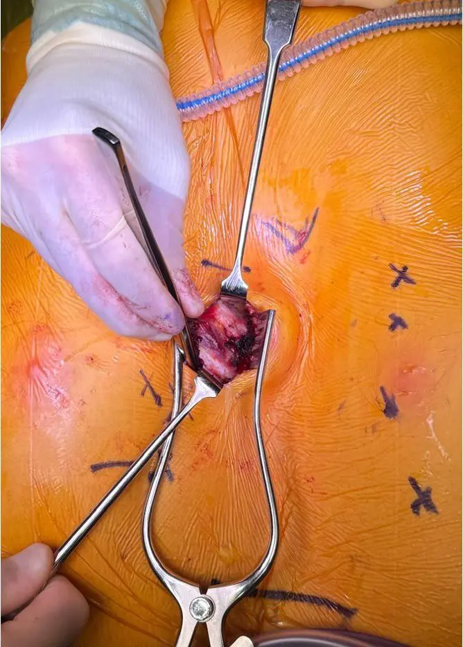 Intra-operative mini-Ravitch cartilage release