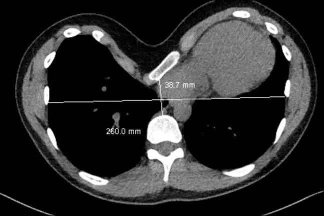 Pre-operative CT showing severe rotated excavatum