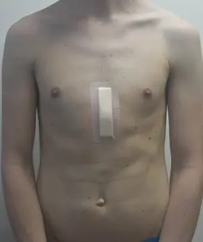Two weeks after surgery