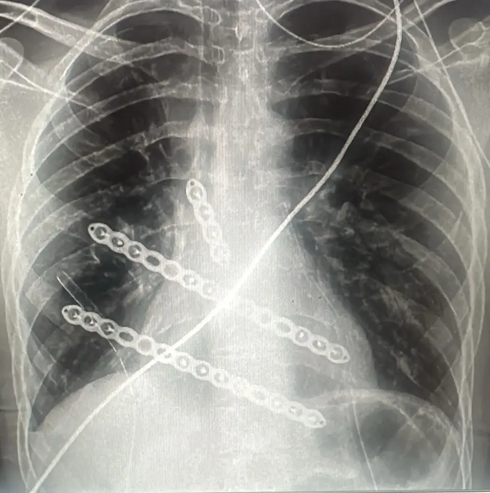 Chest X-ray after a modified Ravitch — titanium plates in place