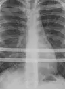 Nuss procedure