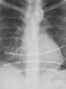 Hybrid pectus surgery