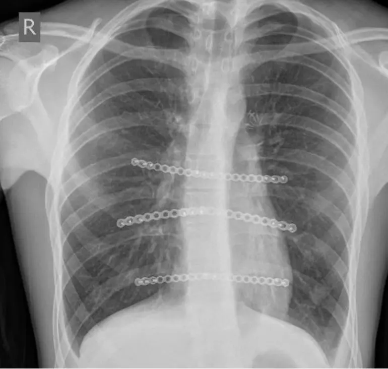 Titanium plates and screws on a post-operative chest X-ray