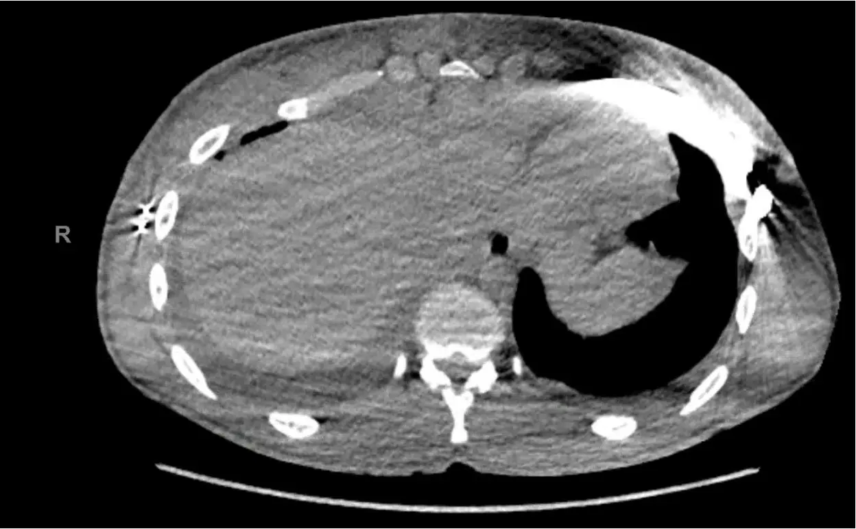 CT after correction — three-bar Nuss repair, Haller index 2.8