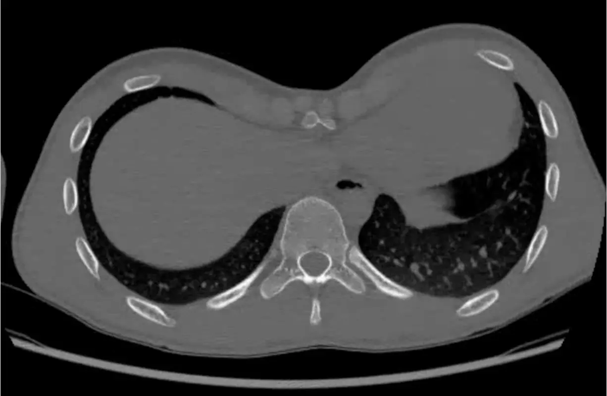 CT before correction — pectus excavatum, Haller index 4.4