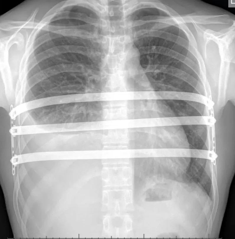 Chest X-ray showing bars in place with a right-sided pleural effusion