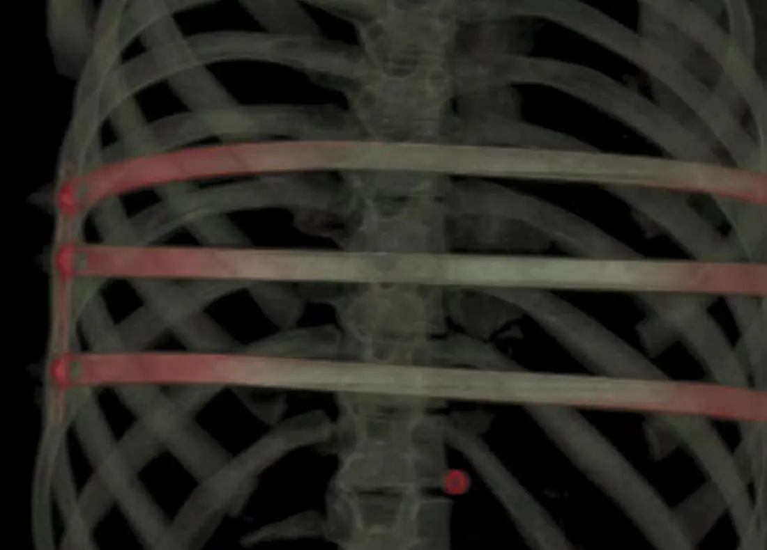 Nuss procedure — Pectus Clinic