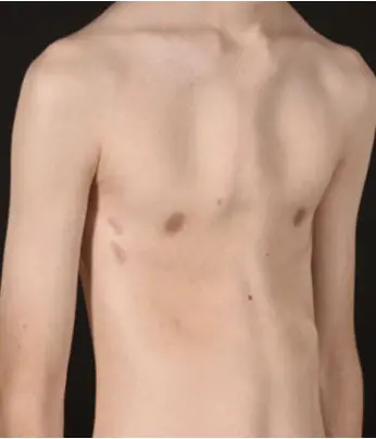 Chest after minimally invasive correction