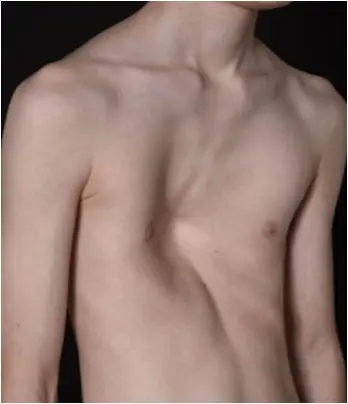 Pectus excavatum before surgery