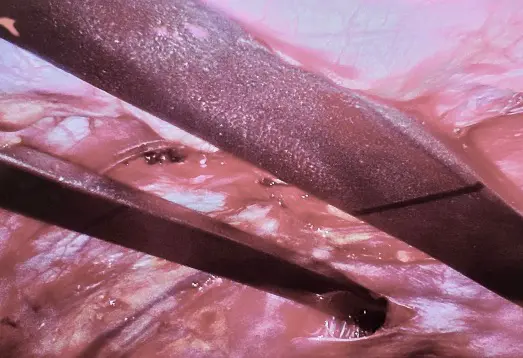 Two pectus bars behind the breastbone