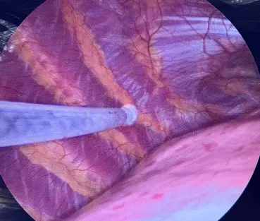 Cryotherapy — intercostal nerves frozen under camera vision