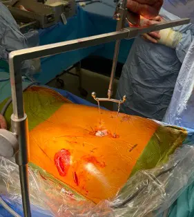Sternal elevation during pectus surgery