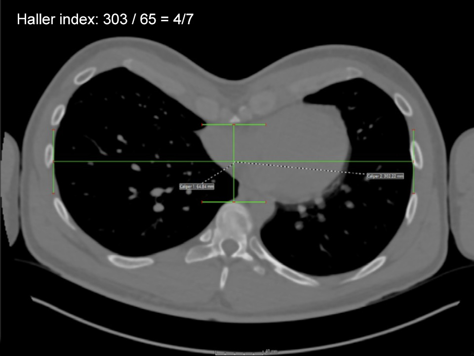 Chest CT showing severity of the pectus excavatum