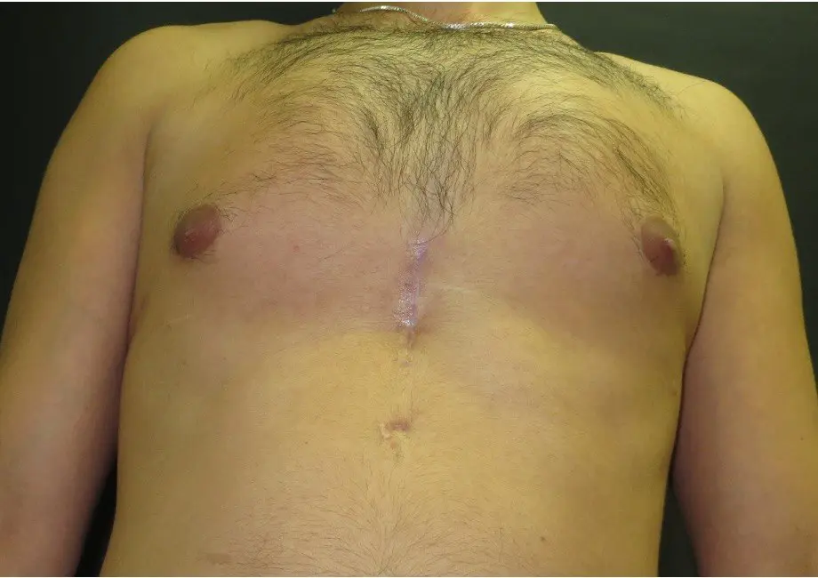 Chest after a custom implant — from below