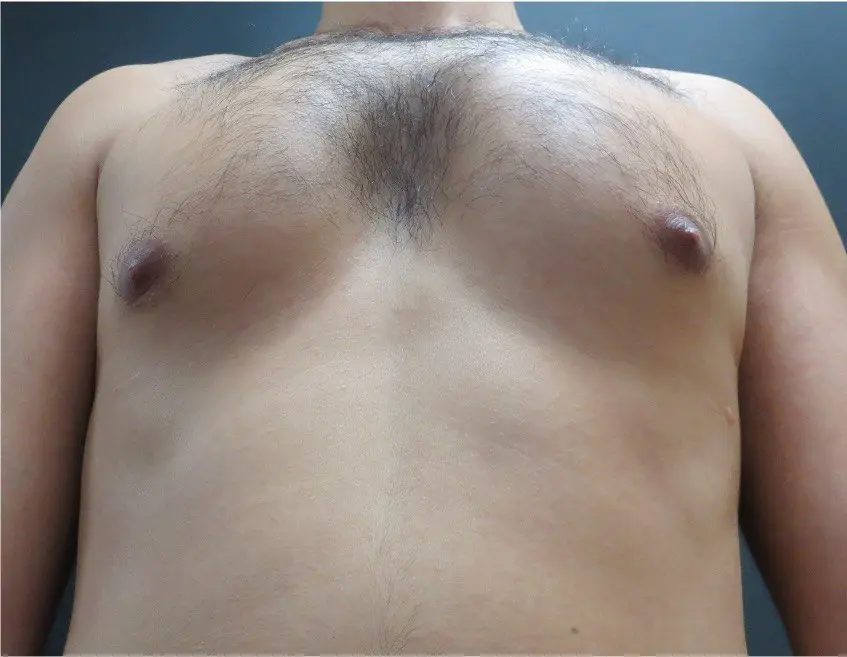 Pectus arcuatum before a custom implant — from below