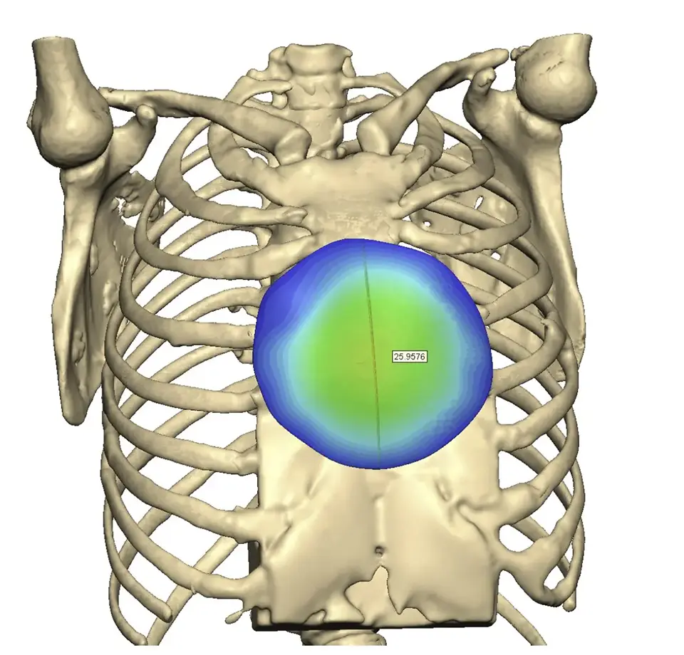 Custom implant designed in 3D on the CT model