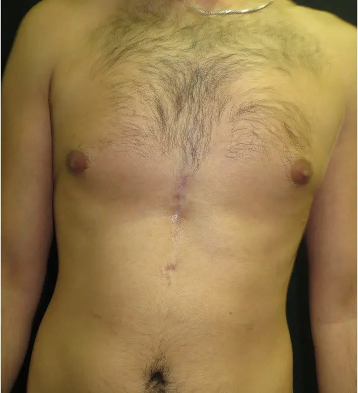 Chest after a custom implant — front