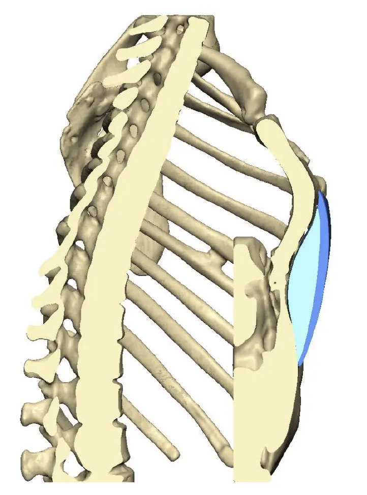Chest wall in profile, with implant