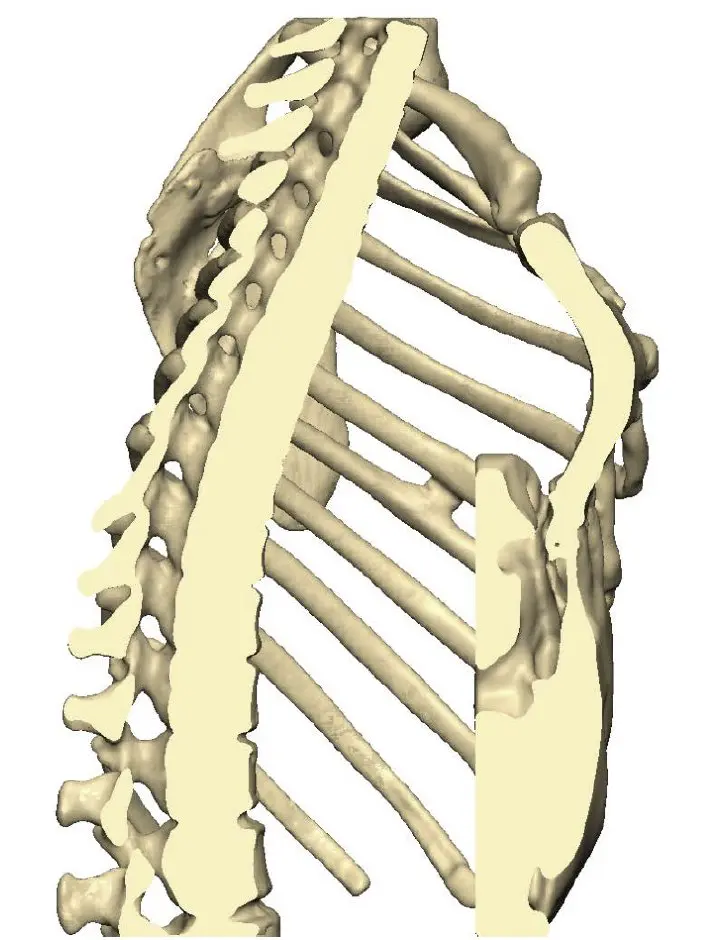 Chest wall in profile, without implant