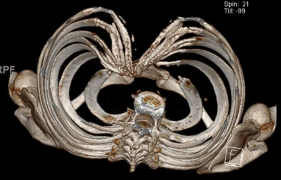 3D CT reconstruction of the chest