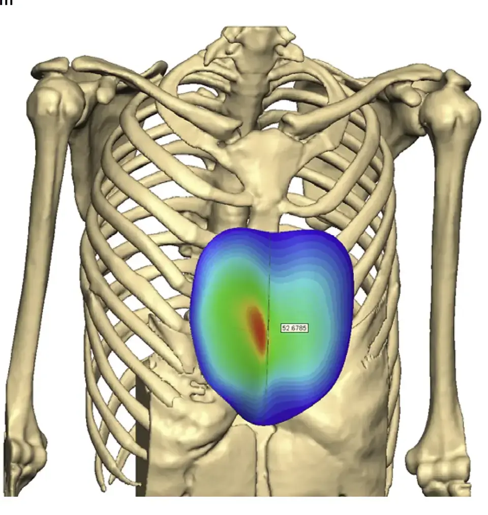 Custom implant designed in 3D on the CT model