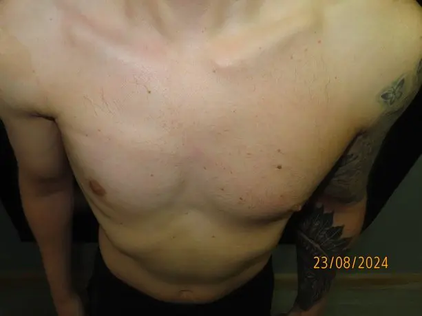 Chest after a custom implant for Poland syndrome