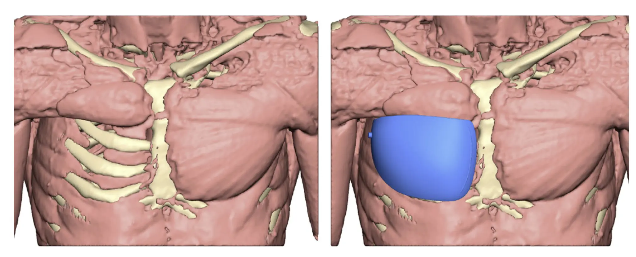 Muscle model — without and with the implant, front