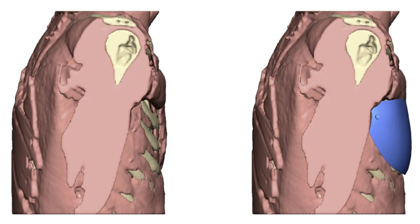 Muscle model — without and with the implant, side