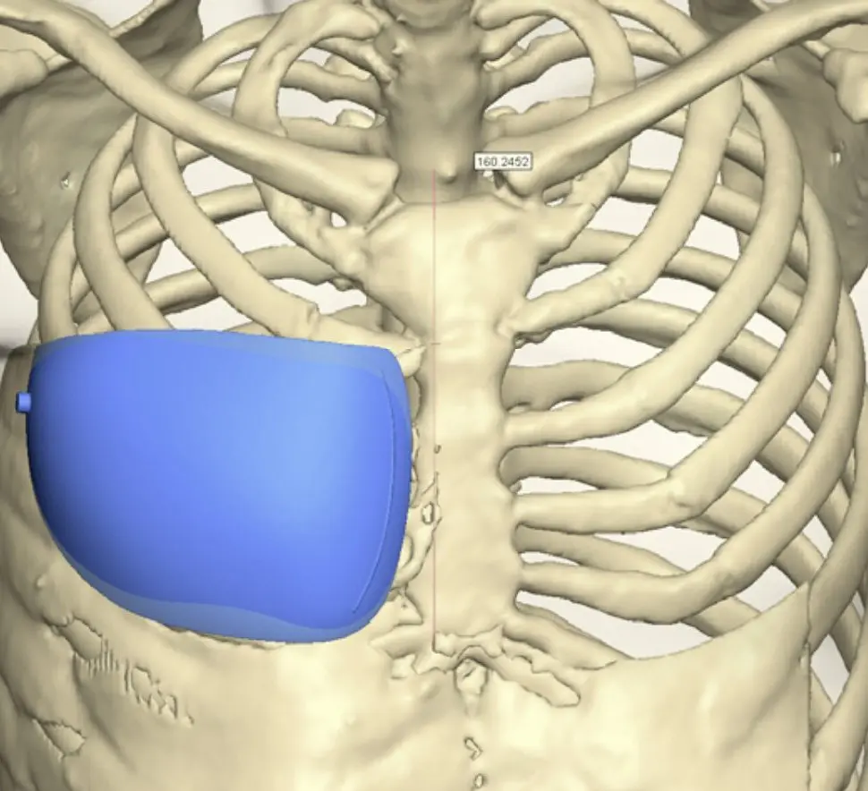 Poland implant designed in 3D, shown on the bony chest wall