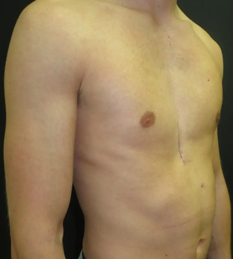 Chest contour after a custom pectus implant