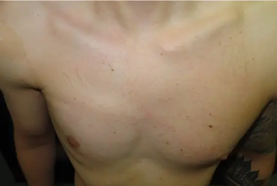 Chest after a custom implant for Poland syndrome