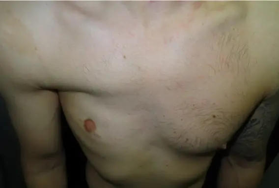 Poland syndrome before a custom implant
