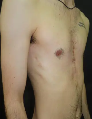 Chest after a revision custom implant