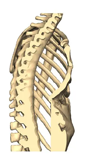 Side view — chest without implant