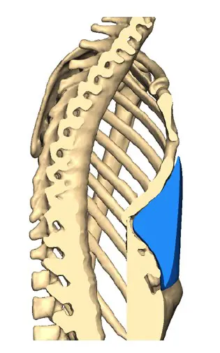 Side view — custom implant in place