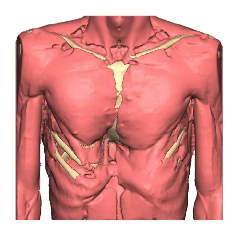 Muscle layer — chest without implant
