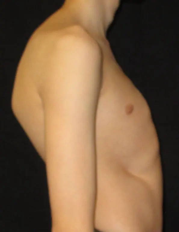 Lateral view showing postural changes associated with pectus deformity