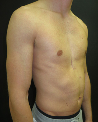 Six weeks after non-corrective surgery with pectus implant
